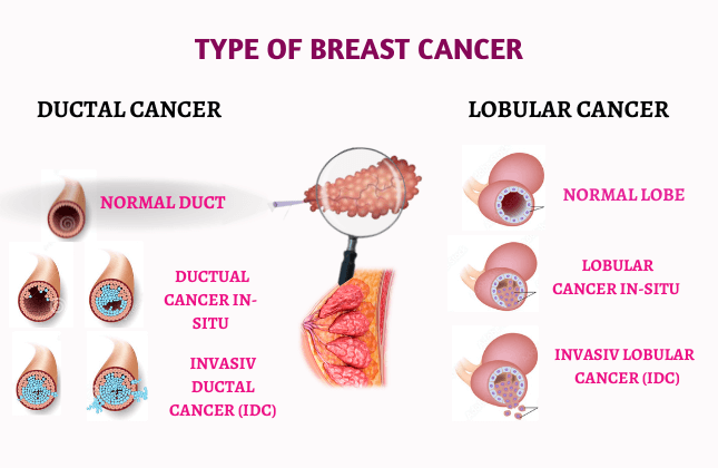 Breast Cancer Treatment - Treat Cancer Now