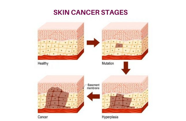 Skin Cancer - Treat Cancer Now