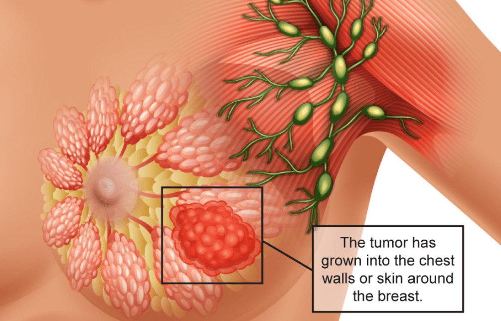 Breast cancer tumor